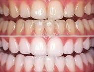 تحقیق سفید کردن دندان